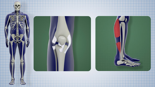 First Aid - Sprains and Strains